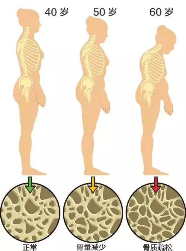 骨质疏松是什么_莆田福德医院